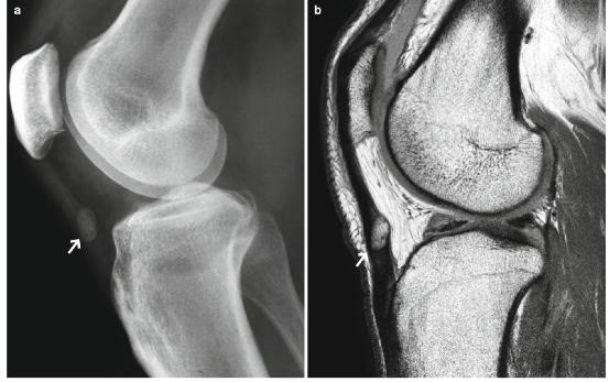 髕腱炎成為醫(yī)學(xué)焦點(diǎn)，從幕后走向舞臺(tái)中央的最新進(jìn)展