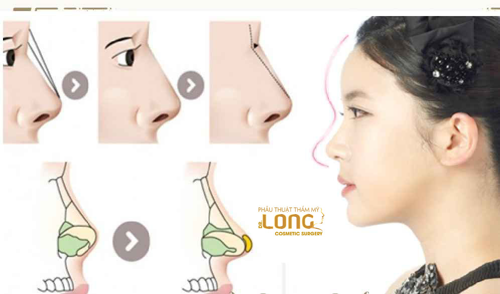 最新鼻整形技術(shù)重塑自信，煥發(fā)新生之美